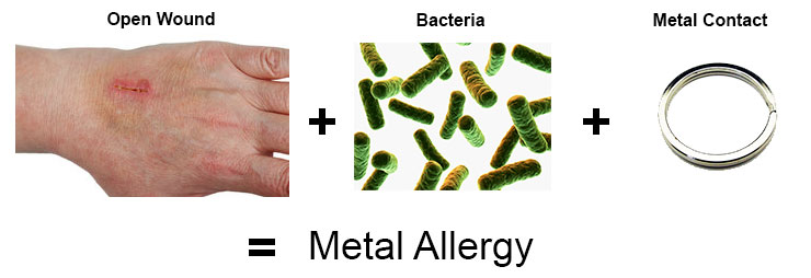 Open wound plus bacteria can result to nickel metal allergy
