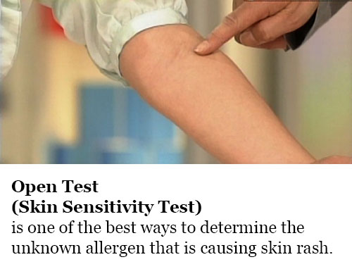 Open Test (Skin Sensitivity Test)