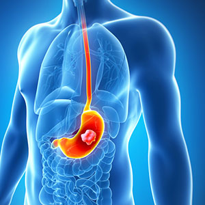 Stomach Cancer and Peptic Ulcer