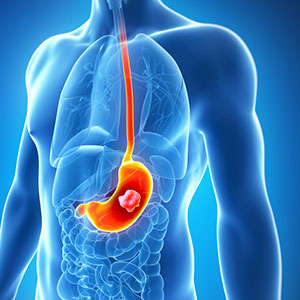 Stomach Cancer and Peptic Ulcer