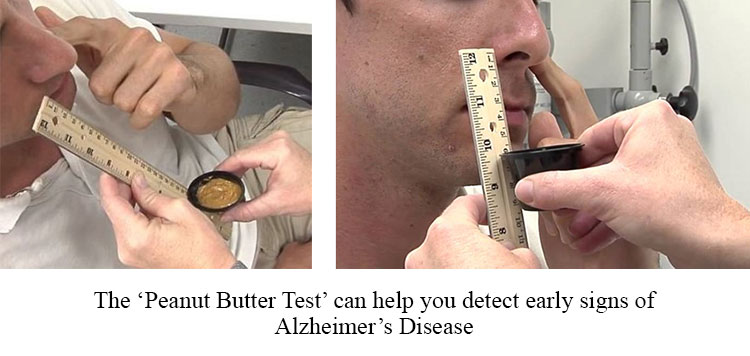 Peanut butter test to detect early signs of Alzheimer's disease