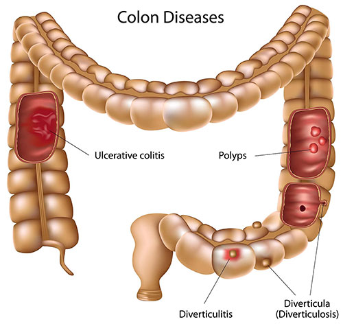 Colonic Diverticulum (Diverticulitis)