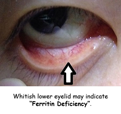 Whitish lower eyelid indicates ferritin deficiency