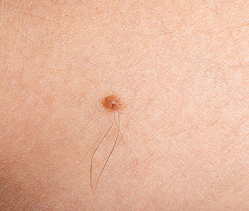 Are Moles With Hair Cancerous 