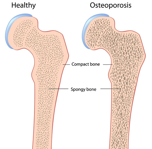 Osteoporosis