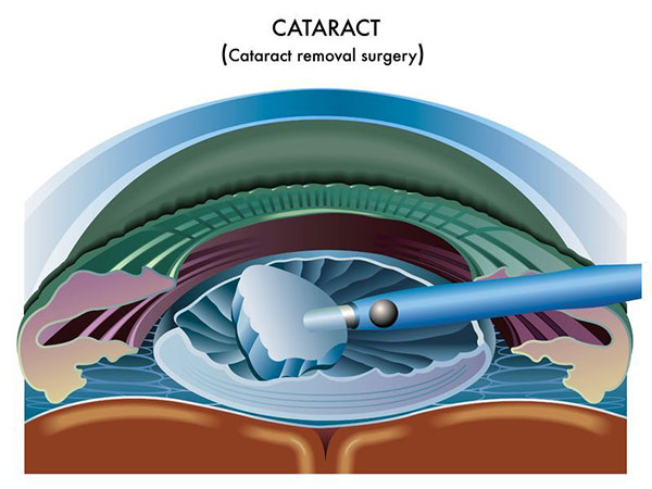 Cataract Removal Surgery