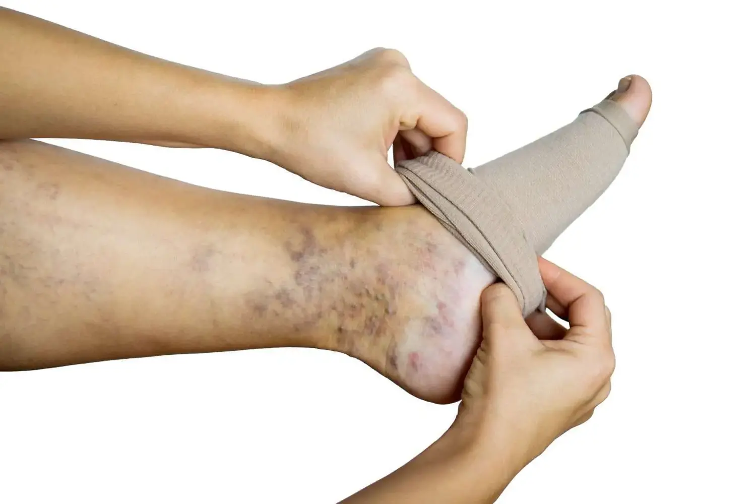 Medical-grade compression stockings designed to improve circulation and reduce leg swelling.