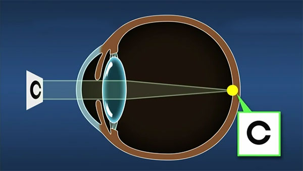 Cortical Cataract