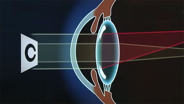 Cortical Cataract