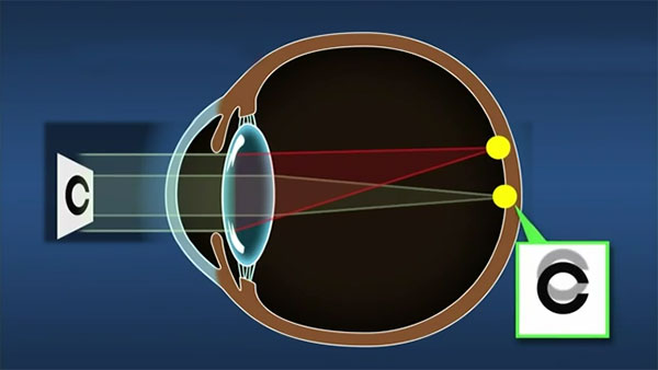 Cortical Cataract