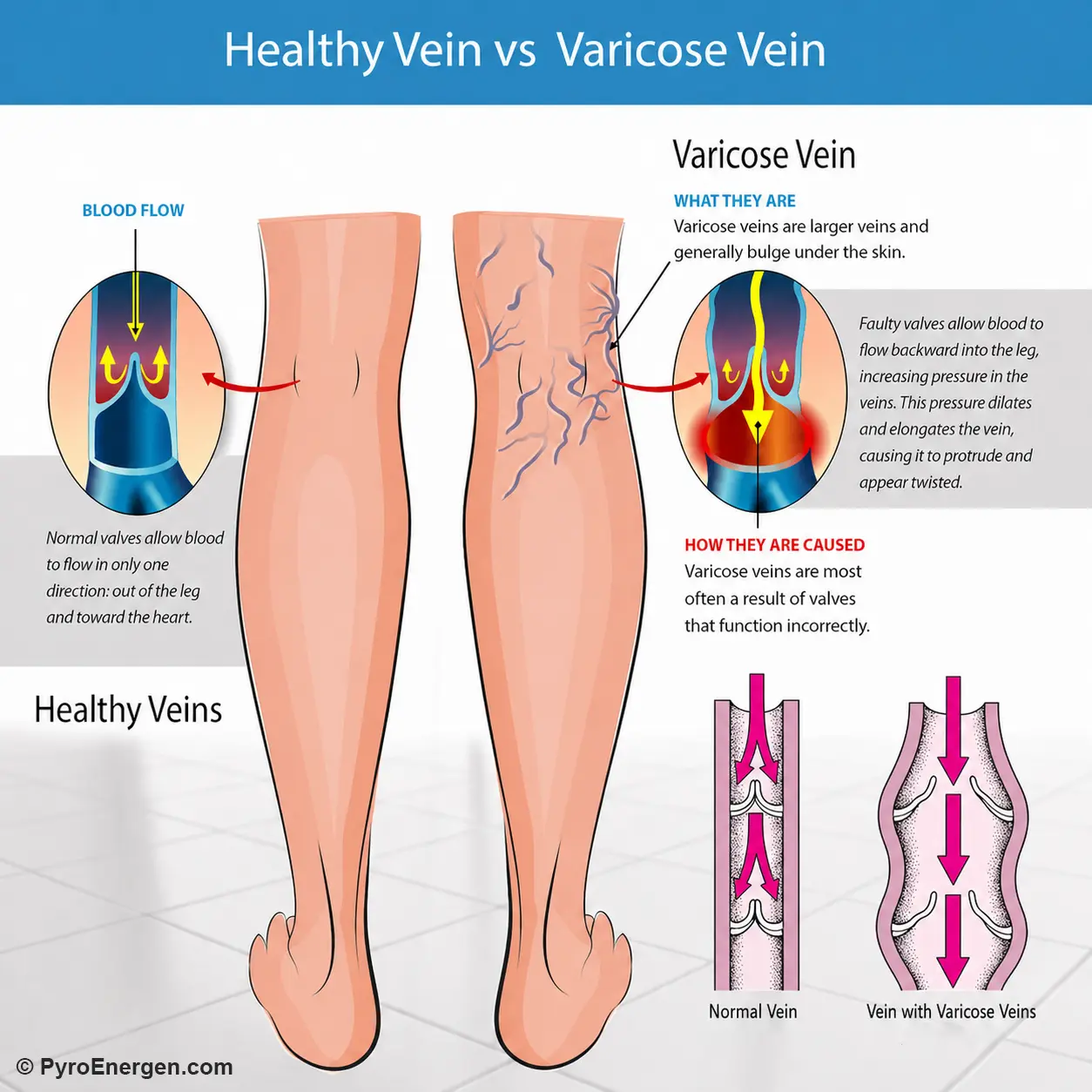 Infographic comparing healthy veins with varicose veins, showing how faulty valves cause blood to pool and veins to bulge in the legs.