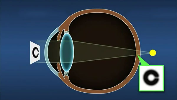 Nuclear Cataract