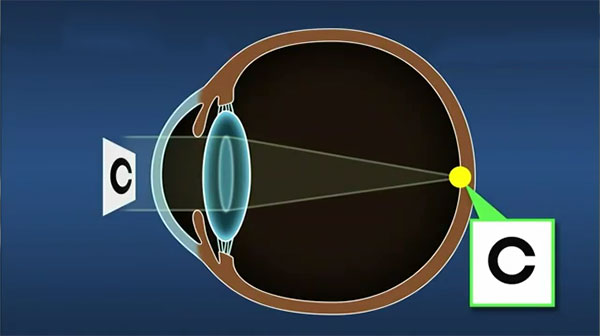 Nuclear Cataract