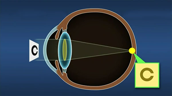 Nuclear Cataract