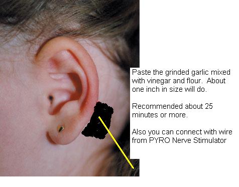 Ear and Nerve Stimulator